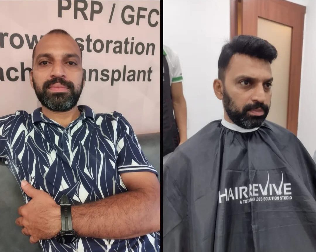 Best Hair Fixing Clinic in Kochi - Hair Revive